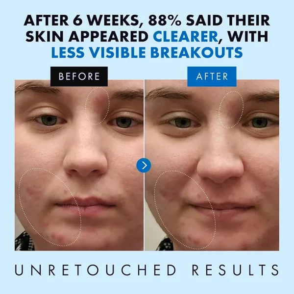 Acne Cream Salicylic Acid Oligopeptides Repair Acne Marks Spots Deep Cleansing Pores Oil Control Moisturizing Skin Care Products - Image 4
