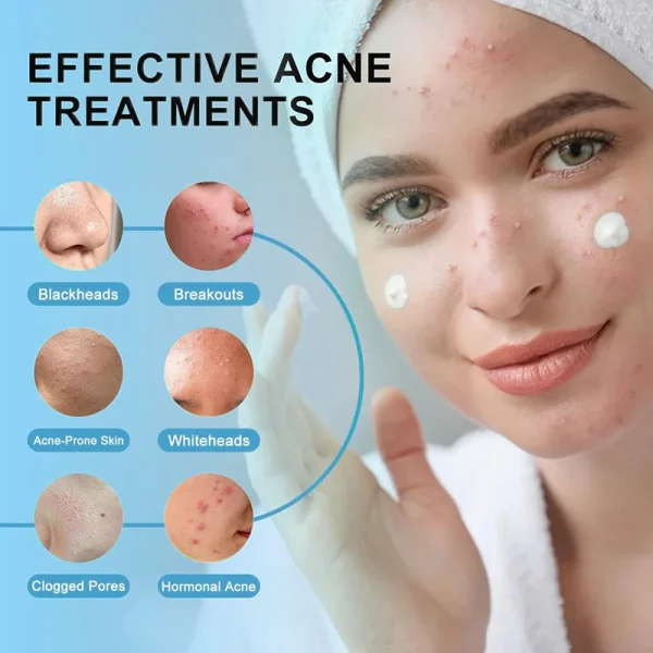 Acne Cream Salicylic Acid Oligopeptides Repair Acne Marks Spots Deep Cleansing Pores Oil Control Moisturizing Skin Care Products - Image 2
