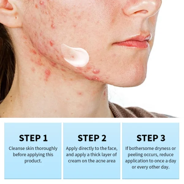 Acne Cream Salicylic Acid Oligopeptides Repair Acne Marks Spots Deep Cleansing Pores Oil Control Moisturizing Skin Care Products - Image 6
